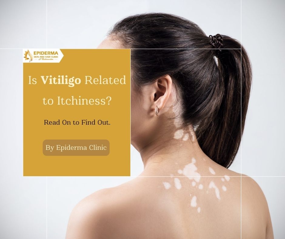 Vitiligo and Itchiness Best Dermatologists in Bangalore Epiderma Clinic