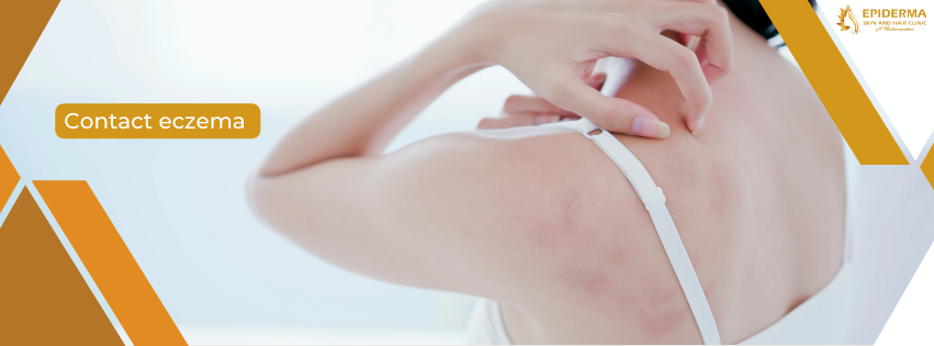 Contact Eczema | Skin Clinic in Jayanagar | Epiderma Clinic