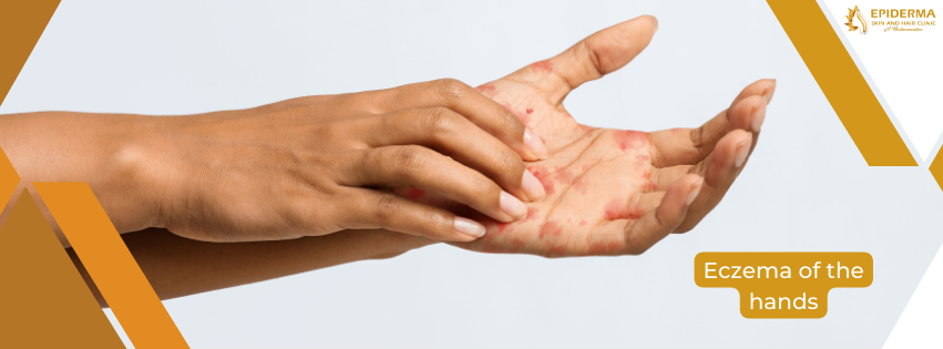 Eczema for hands | Skin Clinic in Jayanagar | Epiderma Clinic
